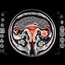 МРТ матки шийки матки