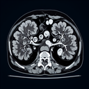 МРТ наднирників
